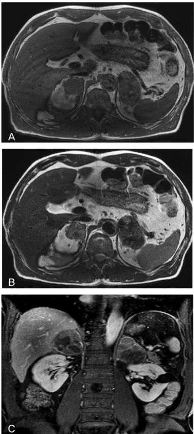 Figure 2.  In  the  upper  abdomen  covered  on  the