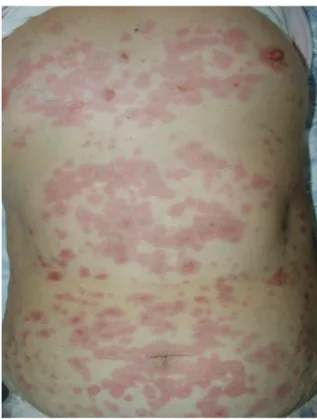 Figure 1. (C)  Toxic  epidermal  necrolysis  invading  more