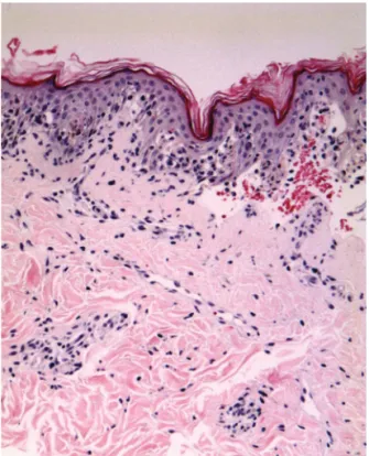 Figure 2.  (B)  Skin  specimens  of  toxic  epidermal