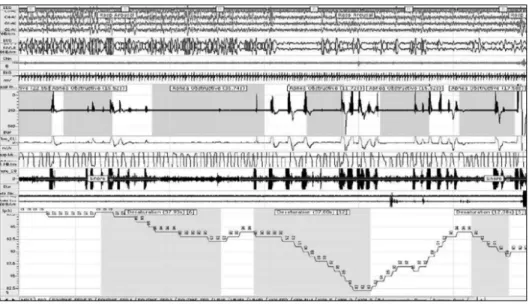 Fig. 1. Polysomnographic record of  obstructive  sleep  apnea.