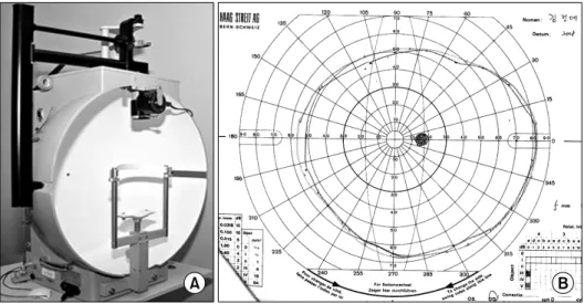 Fig. 2. Goldmann perimetry (A), and  result of visual field of the right eye  tested with Goldmann perimetry (B).