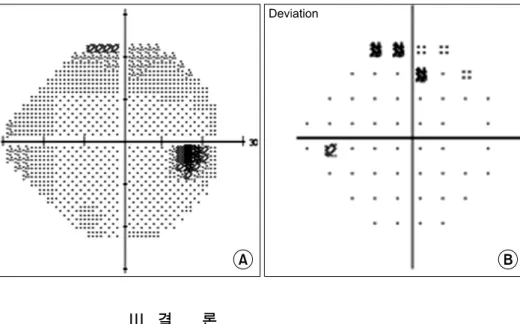 Fig.  5.  Humphrey  Field  Analyzer  output  of  the  right  eye  showing  some blind spots at superior field of vision
