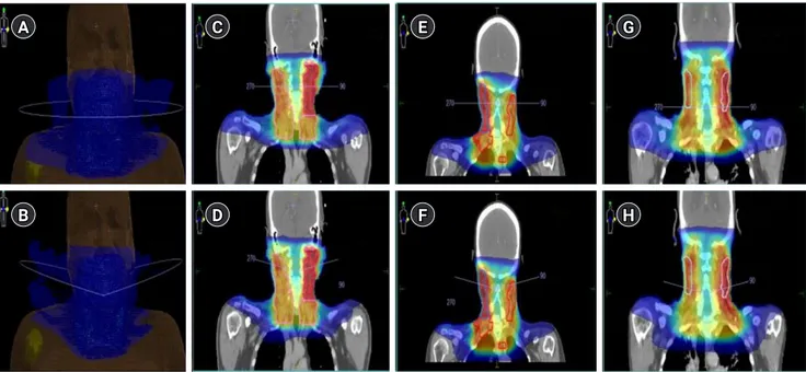 Fig. 1.  The typical beam arrangements of coplanar VMAT plan (A) and non-coplanar VMAT plan (B) for an example case with a dose color wash