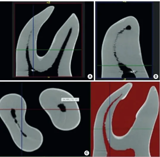 Figure 1.  Micro-computed tomographic image of a tooth showing coronal (A); sagittal (B); axial (C) images with  appropriate thresholding for root canal visualization.