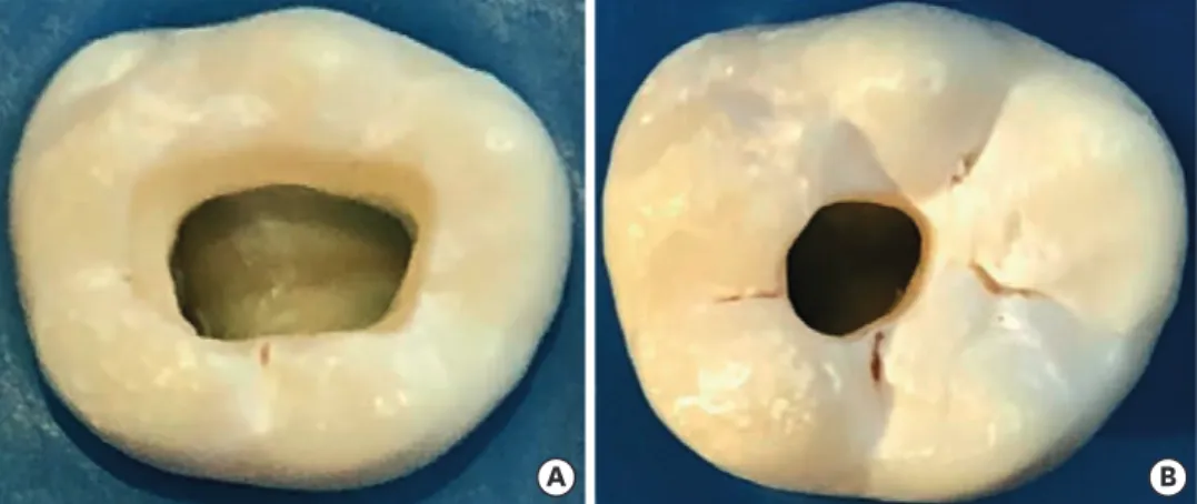 Figure 2.  Photographs of mandibular first molars showing access outlines. (A) TEC. (B) CEC