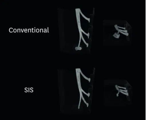 Figure 2.  Three-dimensional models using CTVox software showing the artificial root canals filled with the  conventional system or Sealer Injection System (SIS), and the apical extrusion of Bio-C Sealer after obturation by  both systems