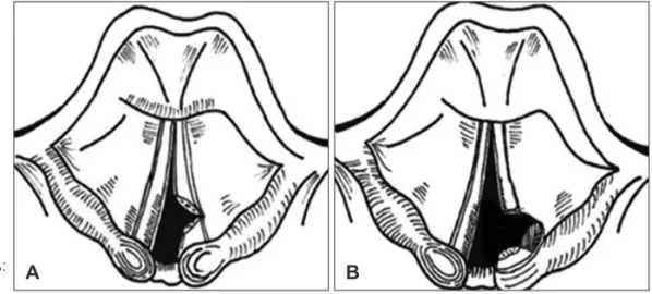 Fig. 2. Diagram of different degrees of arytenoid removal (me-