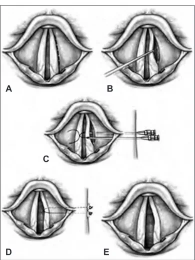 Fig. 4. A: An incision is made lateral and parallel to the vocal fold. 