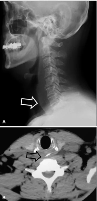Fig. 1. A: The thin radiopaque foreign body (white arrow) was  seen in the simple cervical lateral view