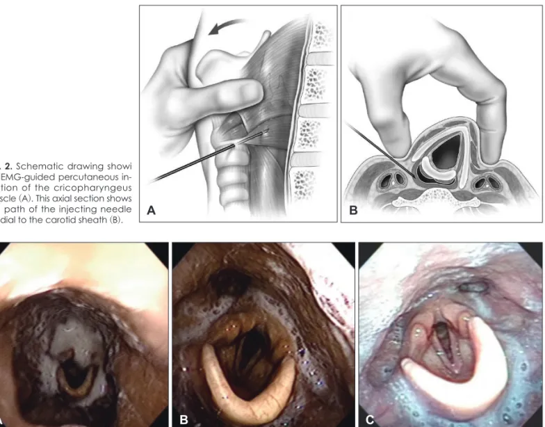 Fig. 2. Schematic drawing showi  ng EMG-guided percutaneous  in-jection of the cricopharyngeus  muscle (A)