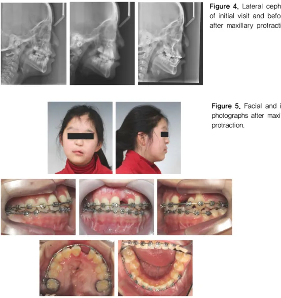 Figure 4. Lateral cephalometrics  of initial visit and before and  after maxillary protraction.