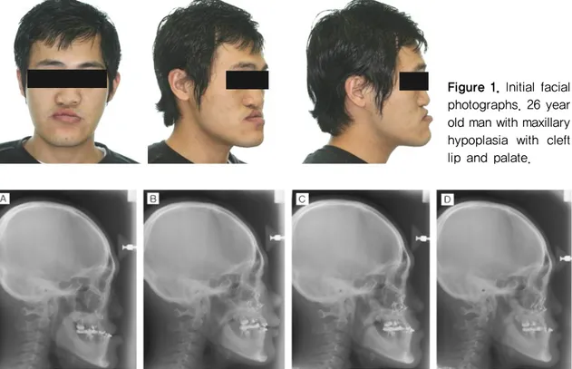 Figure 1. Initial facial  photographs. 26 year  old man with maxillary  hypoplasia  with  cleft  lip and palate