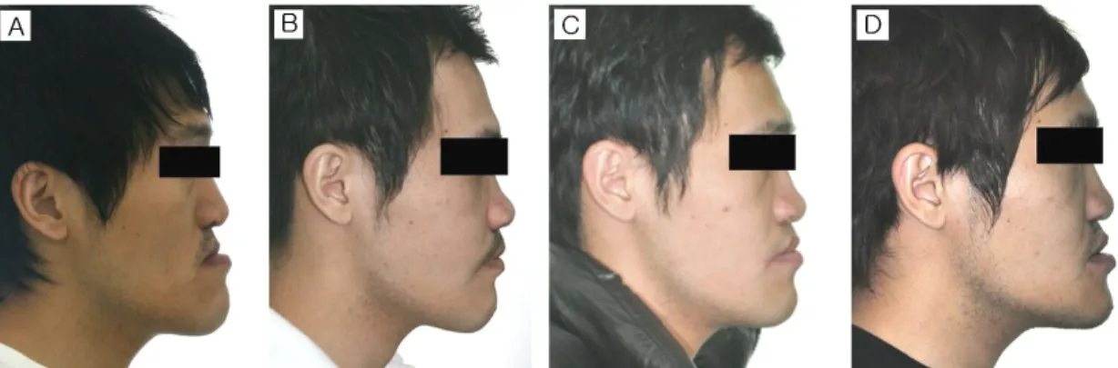 Figure  5.  Lateral  facial  photographs.  Preoperative  photo  (A),  Postoperative  photo  (B),  6-month  postdistraction photo (C), 1-year postdistraction photo (D)