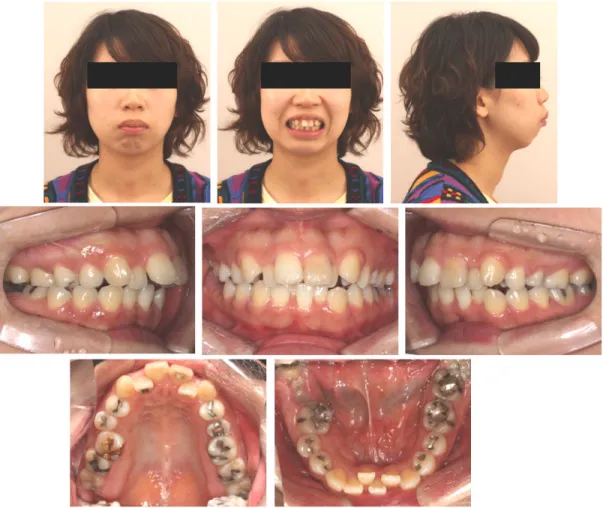 Figure 1. Initial extra-oral and intra-oral photographs.2. 구내소견하악의 우측 제 2 대구치는 심한 치아우식증으로 인해 손상되어 치근 잔존된 상태였다
