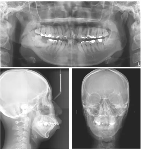 Figure  2.  Initial  radiographs.    4. 진단 및 치료계획위의 분석결과를 토대로 심한 총생 및 하악 대구치 상실을 동반한 골격성 제 II급 1류 부정교합으로 진단하였다