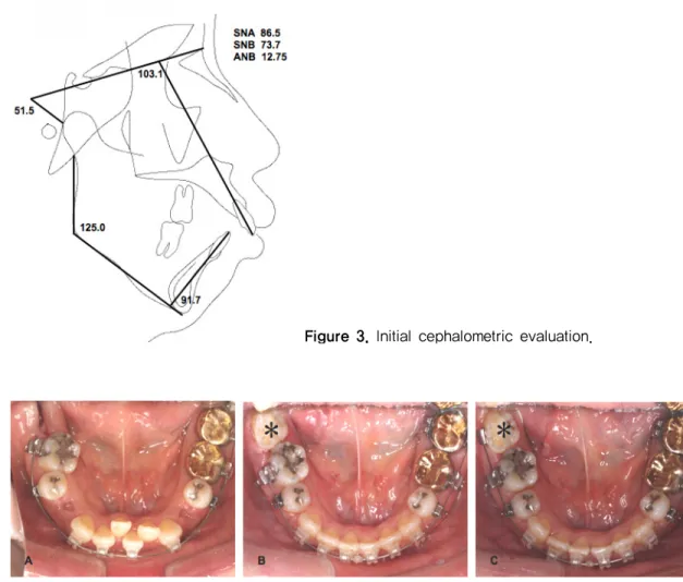 Figure 3. Initial cephalometric evaluation.              