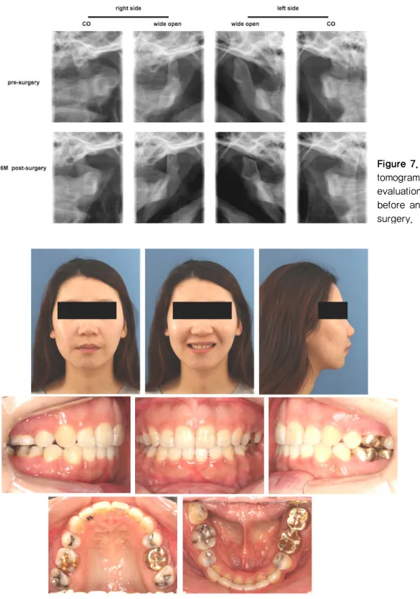 Figure 7. TMJ  tomogram  evaluation  before and after surgery.