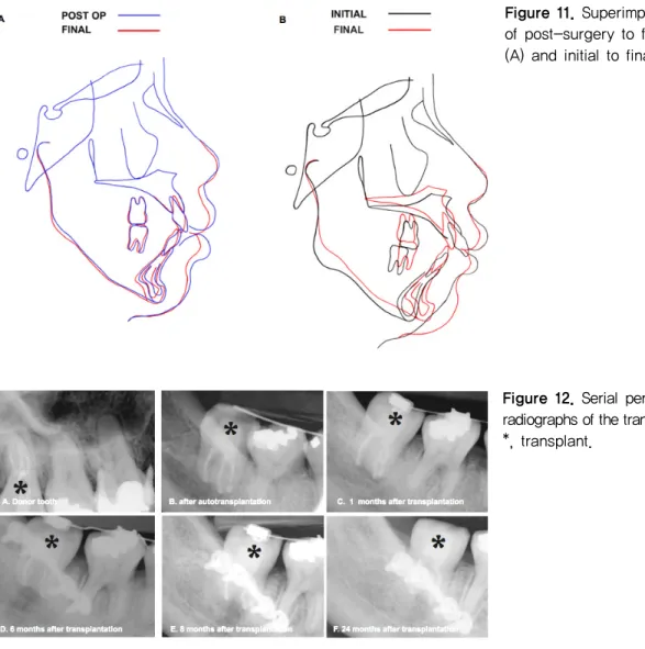 Figure 11. Superimposition  of post-surgery to final  (A) and initial to final (B). 