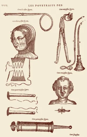 Figure 3. A page from Les Oeuvres by Paré  showing the suturing method for cleft lip repair 1) .하고, 특히 환자가 여자일 때 바람직한 재건 수술을 강조하였다