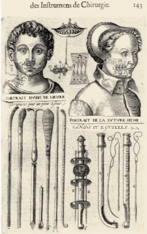 Figure 4. Jacques Guillemeau's instruments  and the dry suture technique. 1)