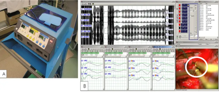 Figure 3.  (A) Electrosurgical unit. (B) Artifacts caused by electrosurgical unit. This was seen when free running EMG and somatosensory evoked  potentials  were  being  averaged.