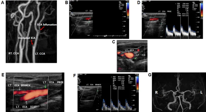 Figure 1.  Internal carotid artery occlusion and cerebral arteries branched from external carotid artery