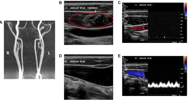 Figure  2.   Internal  jugular  vein  thrombosis.  (A)  Neck  magnetic  resonance  angiography,  (B)  left  internal  jugular  vein  thrombus,  (C)  left  internal  jugular  vein  occlusion,  (D)  right  internal  jugular  vein,  and  (E)  right  internal 