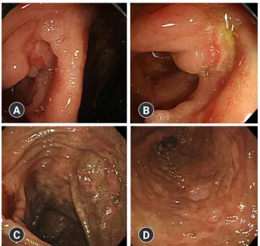 Fig. 4.  Colonoscopic findings. Multiple discontinuous ulcers are  present in the terminal ileum (A, B), cecum, and ascending colon  (C, D)