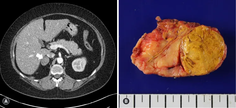 Fig. 1. (A) Abdominal computed tomography reveals a 35×28 mm, hypoattenuating mass (arrow) in the right adrenal gland