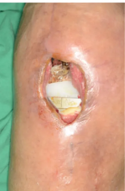 Fig. 1. Preoperative clinical photograph. A 5 ×3-cm skin and  soft tissue defect is seen on the anterolateral area of the knee