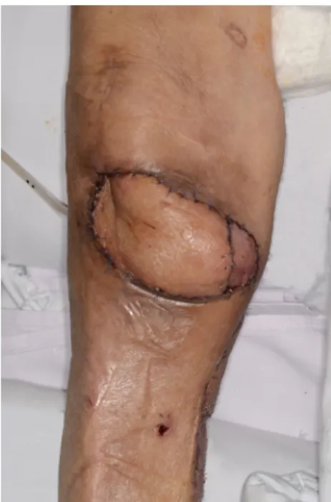 Fig. 5. Intraoperative photograph after the flap was elevated. (A) Upper side of the modified medial gastrocnemius myocutaneous flap