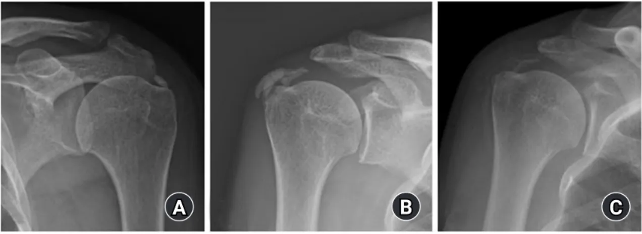 Fig. 2. Distribution of calcific tendinitis by age group. The 50s had  the highest incidence at 45%, 60s were 23%, 40s at 21%, 70s at 6%,  and 30s at 5% by age group.