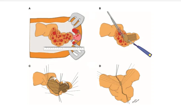 FIGURE 1 | Step-by-step procedures of visceral serosal segmentectomy. (A) Gross evaluation of the length of tumors involving the rectosigmoid colon;