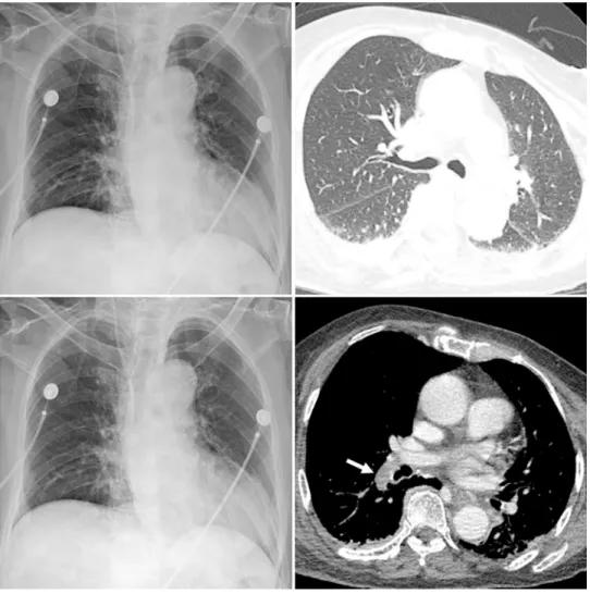 Fig 3. Representative case without COVID-19 pneumonia. A CXR (A) and corresponding chest CT (B) of a patient with fever and dyspnea but negative RT-PCR result for COVID-19 show no pulmonary abnormality suggestive of pneumonia