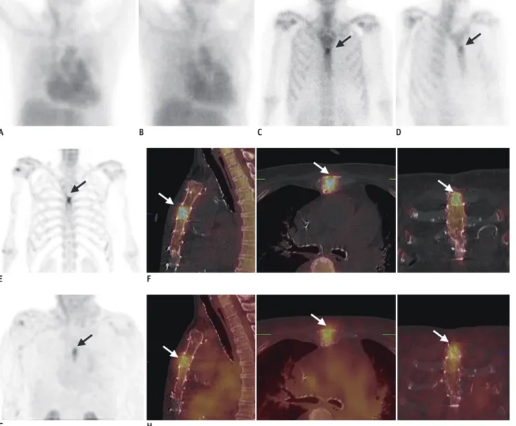 Fig. 1. A 72-year-old female patient with sternal OM (patient no. 11 in Table 1). 