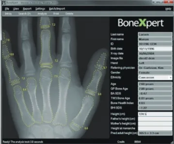 Fig. 4. Automated bone age assessment by VUNO Med-BoneAge.  On receiving the image to be analyzed, VUNO Med-BoneAge suggests  three most likely estimated bone ages (i.e., first-, second-, and third-rank artificial intelligence bone ages) based on probabili