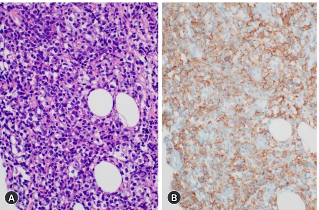 Fig. 2. Histopathologic findings of the needle biopsied soft tissue adjacent to the left sciatic nerve