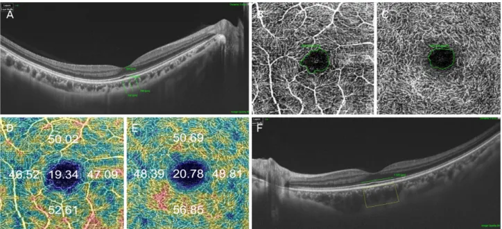 Figure 1. An example of swept-source optical coherence tomography angiography image with thyroid eye disease by one skilled  examiner