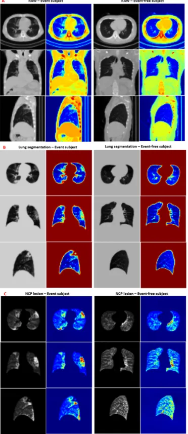 Figure 5.  Gradient-weighted class activation mapping (Grad-CAM) heatmap images for representative event and event-free COVID-19 patients with (A) raw computed tomography (CT) images, (B) lung segmentation images, and (C) novel coronavirus pneumonia (NCP) 