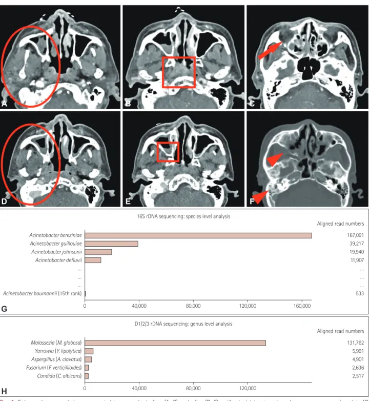 Fig. 1. Enhanced paranasal sinus computed tomography before (A–C) and after (D–F) antibacterial treatment, and nanopore sequencing data (G  and H)