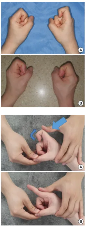 Fig. 2 illustrates extrinsic tightness in both index  fingers. The right side was more severely impacted 