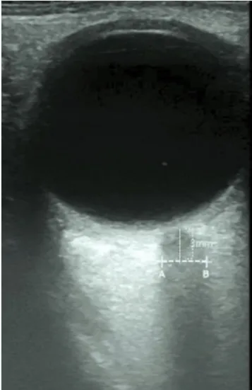 Fig. 1.  Measurement of optic nerve sheath diameter by  ultrasonography. Axial images of the orbit were acquired in the plane  of the optic nerve
