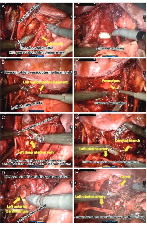 Fig. 1. Procedures for preserving the uterine  artery in robot-assisted radical trachelectomy: (A)  tunneling of the left ureter with the preservation  of the left uterine artery; (B) division of the left  vesicouterine ligament; (C) ligation of the left  