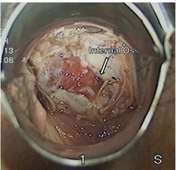 Fig. 2. Postoperative view of the vaginouterine reanastomosis site  at six months after surgery.