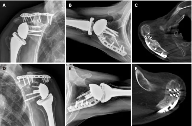 Figure 3 Plain radiographs and computed tomography scan at 2 years after plate fixation show complete healing of the fracture