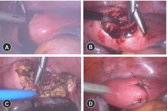 Fig. 2. Laparoscopic mass excision. (A) After incision, chocolate-like fluid was expressed from the cystic cavity