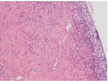 Fig. 4. Pelvic magnetic resonance imaging revealing a large cystic  lesion (accessory cavitated uterine mass, asterisk) localized in  the left side of the uterus, apart from the normal endometrium