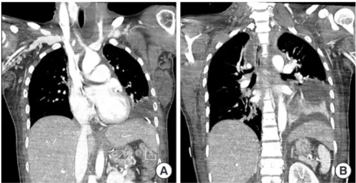 Fig. 3. (A, B) One year follow-up computed tomography scan demon- demon-strated no evidence of inflammation of the neck and mediastinum.