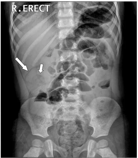 Figure 1. Target sign. This erect abdominal radiograph shows a soft-tissue mass (long arrow) containing concentric circular areas of lucency (short arrow) in the right upper quadrant abdomen.