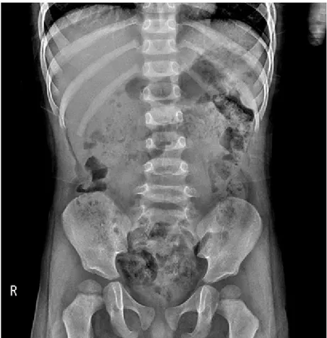 Figure 3. Fecal impaction. This supine abdominal radiograph demonstrates speckled fecal materials in the entire colon.